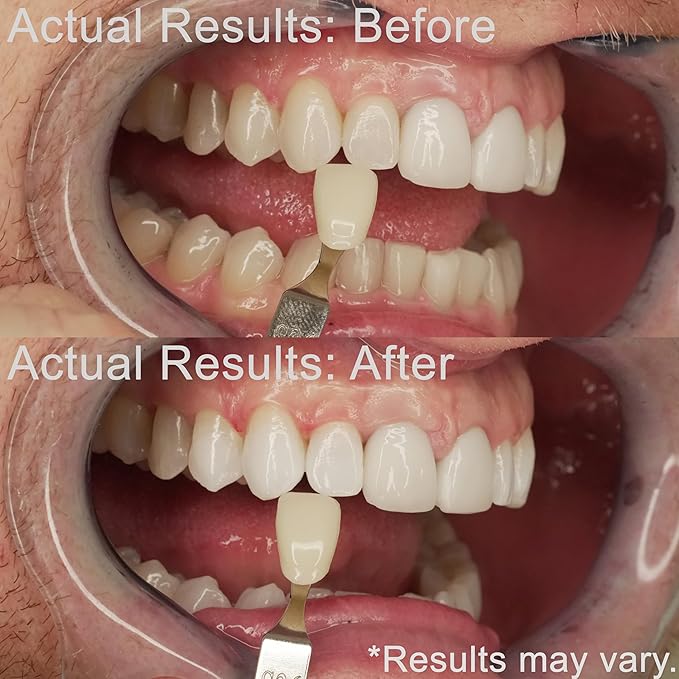 Teeth Whitening Kit for Sensitive Teeth | Overnight Whitener Gel 10% Carbamide Peroxide | for Discolored, Yellow, Brown, Black, Coffee, Smoking