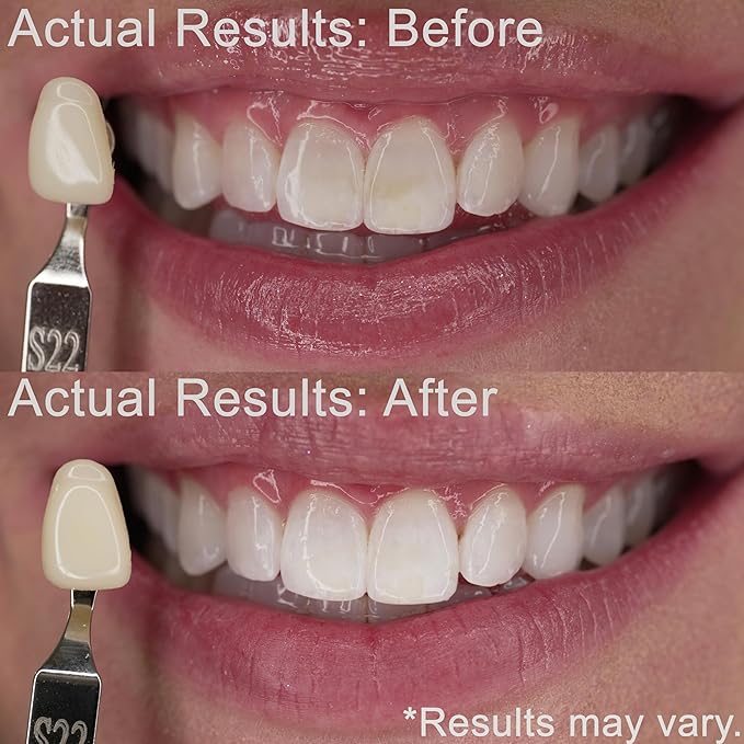 Teeth Whitening Kit for Sensitive Teeth | Overnight Whitener Gel 10% Carbamide Peroxide | for Discolored, Yellow, Brown, Black, Coffee, Smoking